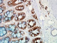 Hsp90 Antibody Clone H9010 IHC staining Human Colon Cancer