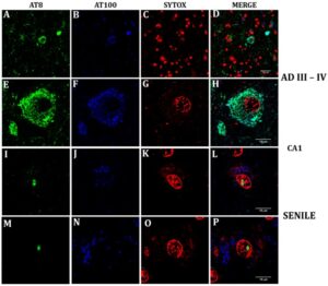 Confocal analysis of nuclear and cytoplasmic phosphorylated Tau in senile CA1 hippocampal neurons and at AD III-IV Braak stages.
