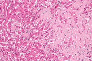 High magnification micrograph of hepatic amyloidosis, also amyloidosis of the liver. 