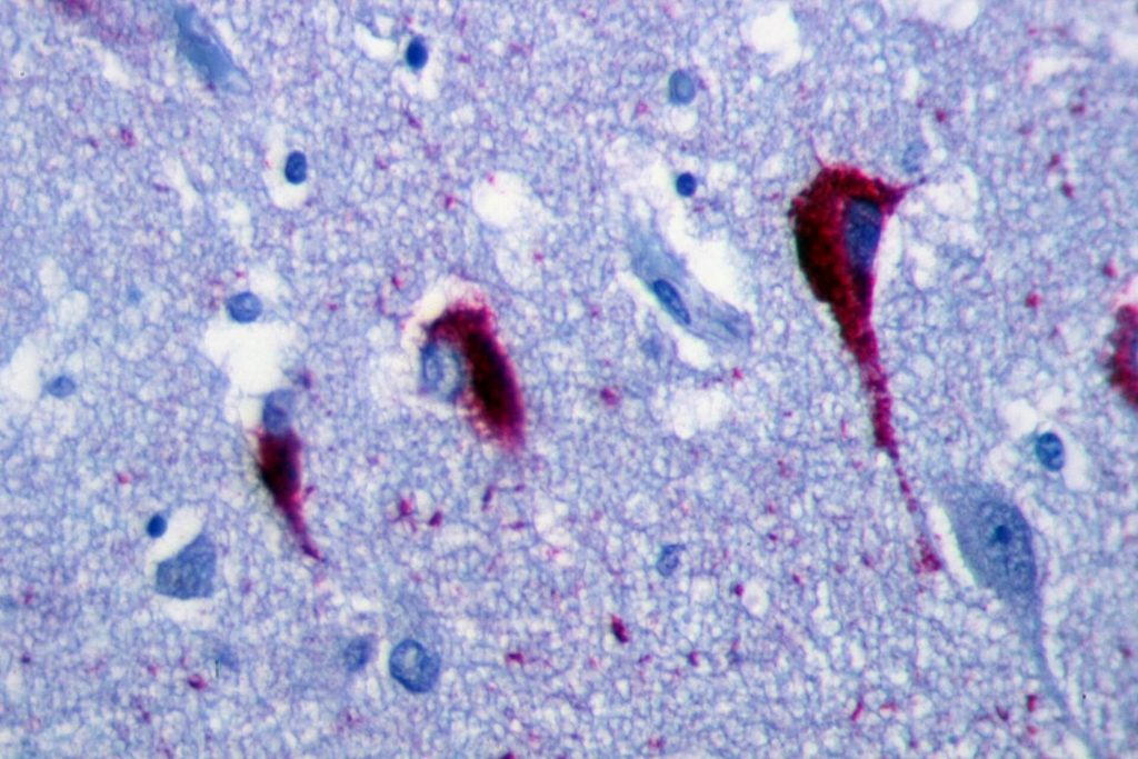 Immunohistochemistry of hippocampus of AD patient shows neurofibrillary tangles.