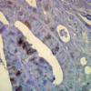 Mouse Anti-Hsp70 Antibody [C92F3A-5] used in Immunohistochemistry (IHC) on Human colon carcinoma (SMC-100)
