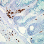 SMC-100_Hsp70_Antibody_C92_IHC_Mouse_colon-carcinoma_40x_1.png