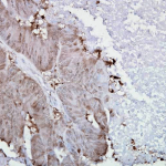SMC-108_Hsp90-alpha_Antibody_K41009_IHC_Human_colon-carcinoma_40x_1.png