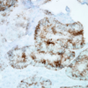 Mouse Anti-Hsp60 Antibody [LK-1] used in Immunohistochemistry (IHC) on Human colon carcinoma (SMC-110)