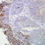 SMC-112_Hsp90_Antibody_AC-16_IHC_Human_colon-carcinoma_40x_1.png