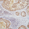 Rat Anti-HSF1 Antibody [10H8] used in Immunohistochemistry (IHC) on Human Breast carcinoma (SMC-118)