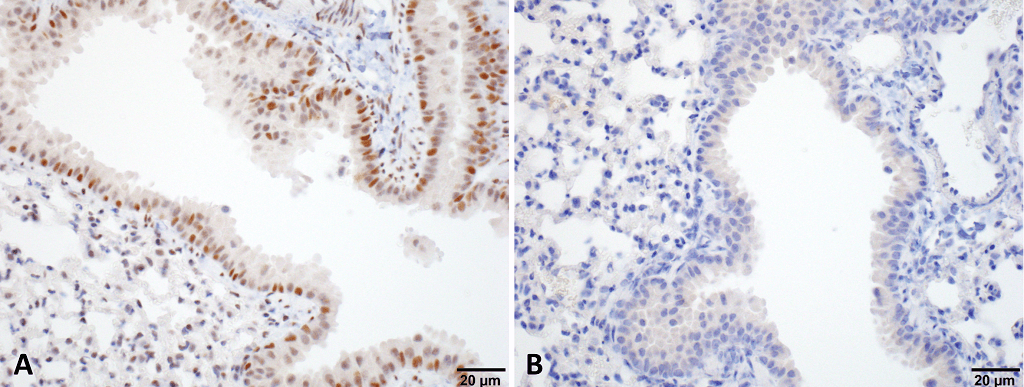 <p>Immunohistochemistry analysis using Rat Anti-HSF1 Monoclonal Antibody, Clone 10H8 (SMC-118). Tissue: Lung. Species: Mouse. Fixation: 10% Formalin Solution for 20 hours at RT. Primary Antibody: Rat Anti-HSF1 Monoclonal Antibody (SMC-118) at 1:1000 for 40 min. Secondary Antibody: Dako labeled Polymer HRP Anti-rat IgG, DAB Chromogen (brown) (Dako Envision+ System) for 30 min at RT. Counterstain: Mayer’s Hematoxylin (purple/blue) nuclear stain for 1 minute at RT. Localization: Nuclear. Magnification: 100X. (A) HSF Wildtype. (B) HSF null. Courtesy of: Dr. Sandro Santagata, Harvard Medical School.</p>
