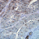 SMC-137_Hsp90_Antibody_D7alpha_IHC_Human_colon-carcinoma_40x_1.png