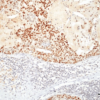 Rat Anti-HSF1 Antibody [10H4] used in Immunohistochemistry (IHC) on Human Breast carcinoma (SMC-476)