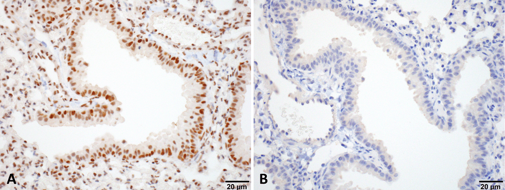 <p>Immunohistochemistry analysis using Rat Anti-HSF1 Monoclonal Antibody, Clone 10H4 (SMC-476). Tissue: Lung. Species: Mouse. Fixation: 10% Formalin Solution for 20 hours at RT. Primary Antibody: Rat Anti-HSF1 Monoclonal Antibody (SMC-476) at 1:1000 for 40 min. Secondary Antibody: Dako labeled Polymer HRP Anti-rat IgG, DAB Chromogen (brown) (Dako Envision+ System) for 30 min at RT. Counterstain: Mayer’s Hematoxylin (purple/blue) nuclear stain for 1 minute at RT. Localization: Nuclear. Magnification: 100X. (A) HSF Wildtype. (B) HSF null. Courtesy of: Dr. Sandro Santagata, Harvard Medical School.</p>
