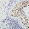 Rat Anti-HSF1 Antibody [4B4] used in Immunohistochemistry (IHC) on Human Breast carcinoma (SMC-477)