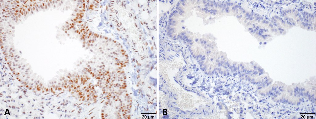 <p>Immunohistochemistry analysis using Rat Anti-HSF1 Monoclonal Antibody, Clone 4B4 (SMC-477). Tissue: Lung. Species: Mouse. Fixation: 10% Formalin Solution for 20 hours at RT. Primary Antibody: Rat Anti-HSF1 Monoclonal Antibody (SMC-477) at 1:1000 for 40 min. Secondary Antibody: Dako labeled Polymer HRP Anti-rat IgG, DAB Chromogen (brown) (Dako Envision+ System) for 30 min at RT. Counterstain: Mayer’s Hematoxylin (purple/blue) nuclear stain for 1 minute at RT. Localization: Nuclear. Magnification: 100X. (A) HSF Wildtype. (B) HSF null. Courtesy of: Dr. Sandro Santagata, Harvard Medical School.</p>
