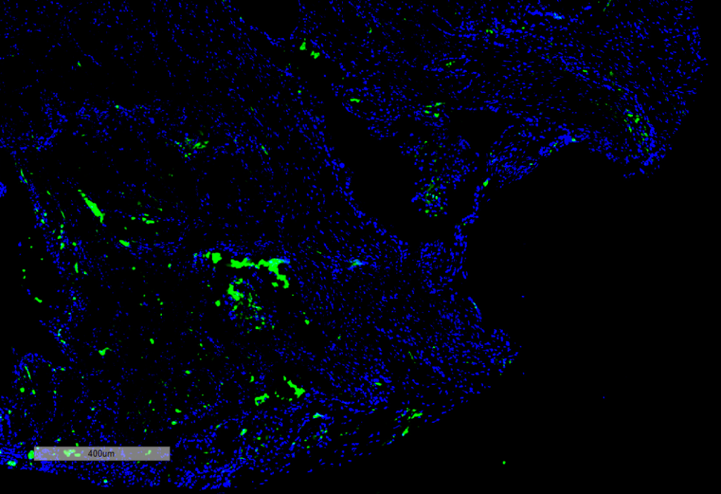 <p>Immunohistochemistry analysis using Mouse Anti-Citrulline Monoclonal Antibody, Clone 2D3.1 (SMC-500). Tissue: Thyroid Cancer. Species: Human. Primary Antibody: Mouse Anti-Citrulline Monoclonal Antibody (SMC-500) at 1:100 for Overnight at 4C, then 30 min at 37C. Secondary Antibody: Goat Anti-Mouse IgG (H+L): FITC for 45 min at 37C. Counterstain: DAPI for 3 min at RT. Magnification: 5X.</p>
