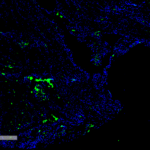 SMC-500_Citrulline_Antibody_2D31_IHC_Human_Thyroid-Cancer_1.png