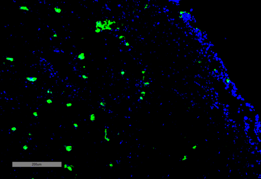 <p>Immunohistochemistry analysis using Mouse Anti-Acrolein Monoclonal Antibody, Clone 10A10 (SMC-505). Tissue: Adrenal Carcinoma. Species: Human. Primary Antibody: Mouse Anti-Acrolein Monoclonal Antibody (SMC-505) at 1:100 for Overnight at 4C, then 30 min at 37C. Secondary Antibody: Goat Anti-Mouse IgG (H+L): FITC for 45 min at 37C. Counterstain: DAPI for 3 min at RT. Magnification: 5X.</p>
