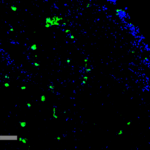 SMC-505_Acrolein_Antibody_10A10_IHC_Human_Adrenal-Carcinoma_1.png