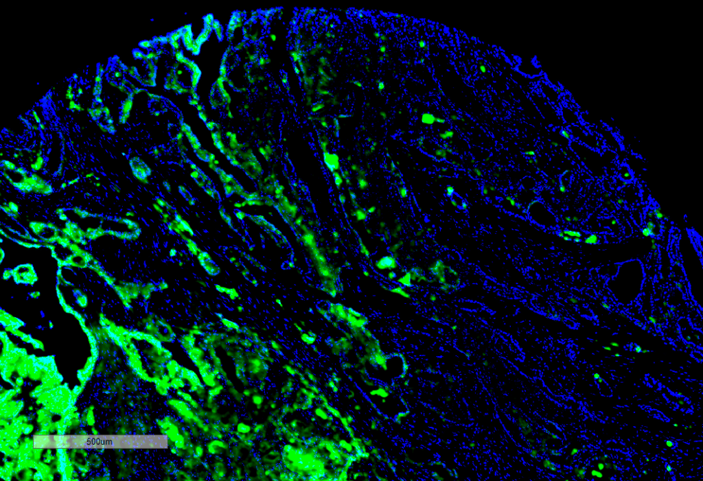 <p>Immunohistochemistry analysis using Mouse Anti-Thyroid Hormone Receptor Monoclonal Antibody, Clone H43 (SMC-561). Tissue: Thyroid Cancer. Species: Human. Primary Antibody: Mouse Anti-Thyroid Hormone Receptor Monoclonal Antibody (SMC-561) at 1:100 for Overnight at 4C, then 30 min at 37C. Secondary Antibody: Goat Anti-Mouse IgG (H+L): FITC for 45 min at 37C. Counterstain: DAPI for 3 min at RT. Magnification: 4X.</p>
