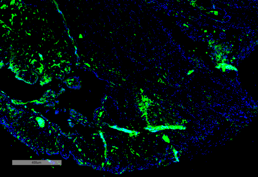 <p>Immunohistochemistry analysis using Mouse Anti-Parvalbumin Monoclonal Antibody, Clone C12 (SMC-563). Tissue: Thyroid Cancer. Species: Human. Primary Antibody: Mouse Anti-Parvalbumin Monoclonal Antibody (SMC-563) at 1:100 for Overnight at 4C, then 30 min at 37C. Secondary Antibody: Goat Anti-Mouse IgG (H+L): FITC for 45 min at 37C. Counterstain: DAPI for 3 min at RT. Magnification: 5X.</p>
