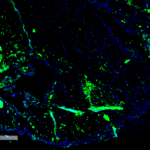 SMC-563_Parvalbumin_Antibody_C12_IHC_Human_Thyroid-Cancer_1.png