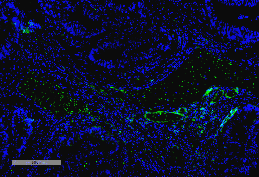 <p>Immunohistochemistry analysis using Mouse Anti-VPS35 Monoclonal Antibody, Clone 10A8 (SMC-605). Tissue: Thyroid Cancer. Species: Human. Primary Antibody: Mouse Anti-VPS35 Monoclonal Antibody (SMC-605) at 1:100 for Overnight at 4C, then 30 min at 37C. Secondary Antibody: Goat Anti-Mouse IgG (H+L): FITC for 45 min at 37C. Counterstain: DAPI for 3 min at RT. Magnification: 10X.</p>
