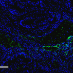 SMC-605_VPS35_Antibody_10A8_IHC_Human_Thyroid-Cancer_1.png