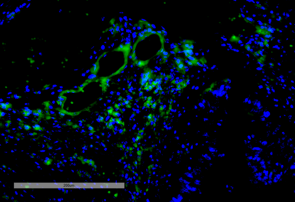 <p>Immunohistochemistry analysis using Mouse Anti-VPS35 Monoclonal Antibody, Clone 11H10 (SMC-606). Tissue: Intestinal Cancer. Species: Human. Primary Antibody: Mouse Anti-VPS35 Monoclonal Antibody (SMC-606) at 1:100 for Overnight at 4C, then 30 min at 37C. Secondary Antibody: Goat Anti-Mouse IgG (H+L): FITC for 45 min at 37C. Counterstain: DAPI for 3 min at RT. Magnification: 20X.</p>

