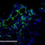 SMC-606_VPS35_Antibody_11H10_IHC_Human_Intestinal-Cancer_1.png