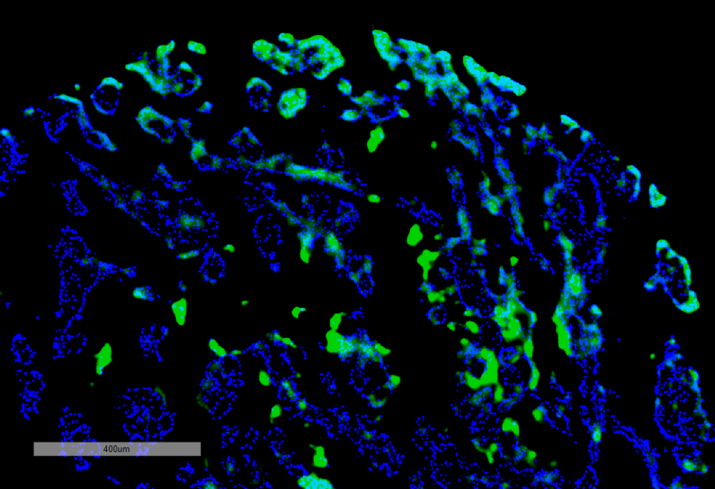 <p>Immunohistochemistry analysis using Rabbit Anti-Thymidine Glycol Monoclonal Antibody, Clone B29 (SMC-611). Tissue: renal cancer. Species: Human. Primary Antibody: Rabbit Anti-Thymidine Glycol Monoclonal Antibody (SMC-611) at 1:100 for Overnight at 4C, then 30 min at 37C. Secondary Antibody: Goat Anti-Mouse IgG (H+L): FITC for 45 min at 37C. Counterstain: DAPI for 3 min at RT.</p>
