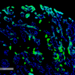 SMC-611_Thymidine-Glycol_Antibody_B29_IHC_Human_renal-cancer_1.png