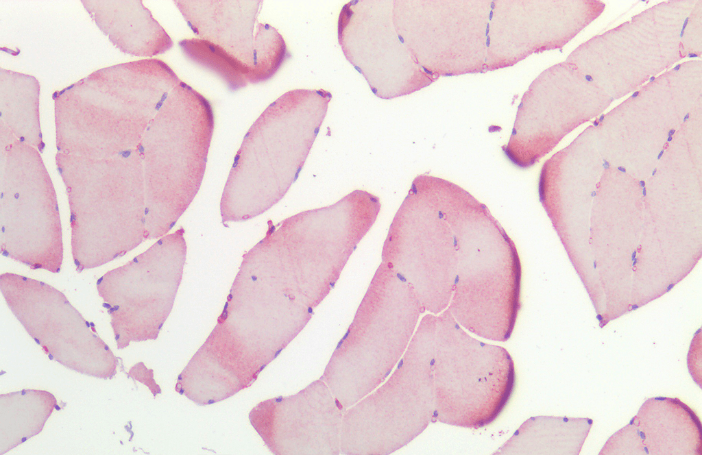 <p>Immunohistochemistry analysis using Rabbit Anti-HSP27 Polyclonal Antibody (SPC-106). Tissue: Skeletal Muscle. Species: Human. Fixation: Formalin fixed paraffin-embedded. Primary Antibody: Rabbit Anti-HSP27 Polyclonal Antibody (SPC-106).</p>
