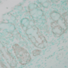 Rabbit Anti-Ubiquitin Antibody used in Immunohistochemistry (IHC) on Human colon carcinoma (SPC-119)