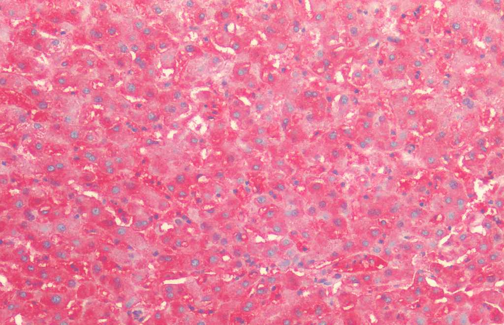 <p>Immunohistochemistry analysis using Rabbit Anti-HSP60 Polyclonal Antibody (SPC-185). Tissue: Liver. Species: Human. Fixation: Formalin fixed paraffin-embedded. Primary Antibody: Rabbit Anti-HSP60 Polyclonal Antibody (SPC-185).</p>
