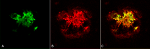 SPC-506. Amyloid Oligomers A11-Antibody IHC-Human Alzheimer's Disease brain 