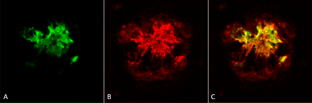 <p>Immunohistochemistry analysis using Rabbit Anti-Amyloid Oligomers (A11) Polyclonal Antibody (SPC-506). Tissue: Alzheimer’s Disease brain. Species: Human. Fixation: Formalin fixed. Primary Antibody: Rabbit Anti-Amyloid Oligomers (A11) Polyclonal Antibody (SPC-506) at 1:1000. Secondary Antibody: Goat Anti-Rabbit ATTO 594 (red). Localization: Plaque. (A) Amyloid Fibril (OC) Antibody (SPC-507). (B) Amyloid Oligomer (A11) Antibody (SPC-506). (C) Composite. Courtesy of: Dr. Elizabeth Head, University of California, Irvine.</p>
