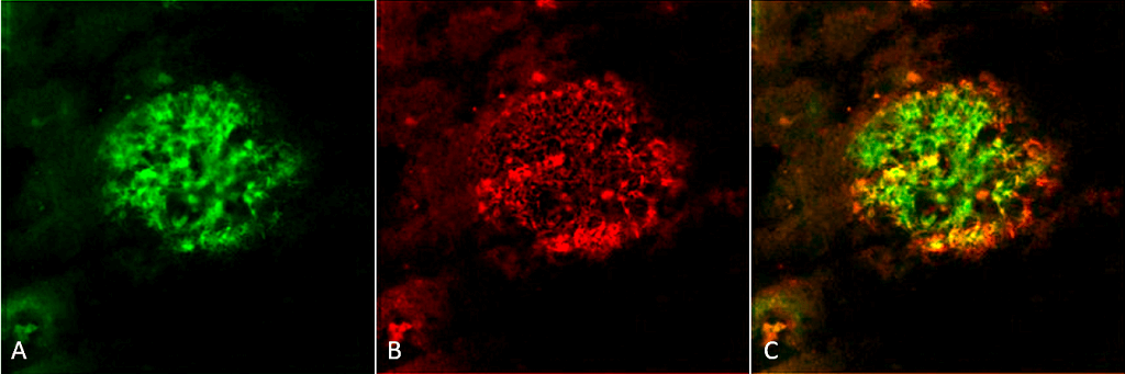 <p>Immunohistochemistry analysis using Rabbit Anti-Amyloid Fibrils (OC) Polyclonal Antibody (SPC-507). Tissue: Alzheimer’s Disease brain. Species: Human. Fixation: Formalin fixed. Primary Antibody: Rabbit Anti-Amyloid Fibrils (OC) Polyclonal Antibody (SPC-507) at 1:5000. Secondary Antibody: Goat Anti-Rabbit ATTO 488 (green). Localization: Plaque. (A) Amyloid Fibril (OC) Antibody (SPC-507). (B) Amyloid Oligomer (A11) Antibody (SPC-506). (C) Composite. Courtesy of: Dr. Elizabeth Head, University of California, Irvine.</p>
