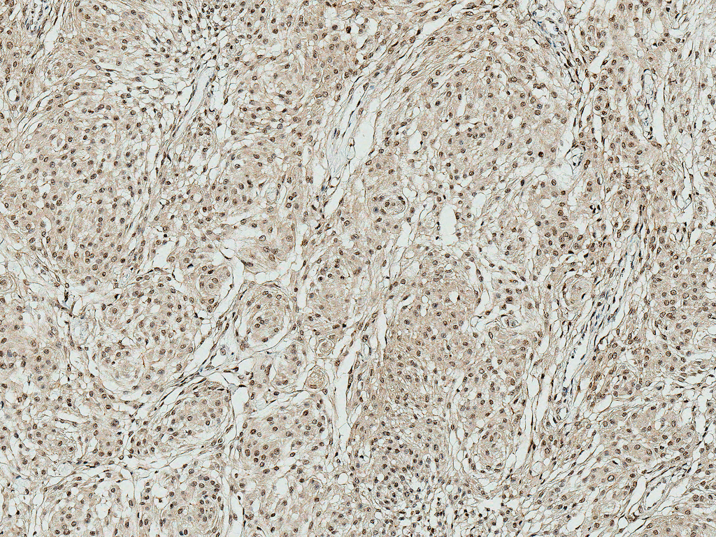 <p>Immunohistochemistry analysis using Rabbit Anti-ATG10 Polyclonal Antibody (SPC-610). Tissue: Brain. Species: Human. Fixation: Formalin Fixed Paraffin-Embedded. Primary Antibody: Rabbit Anti-ATG10 Polyclonal Antibody (SPC-610) at 1:50 for 31 min at RT. Counterstain: Hematoxylin. Magnification: 10X.</p>
