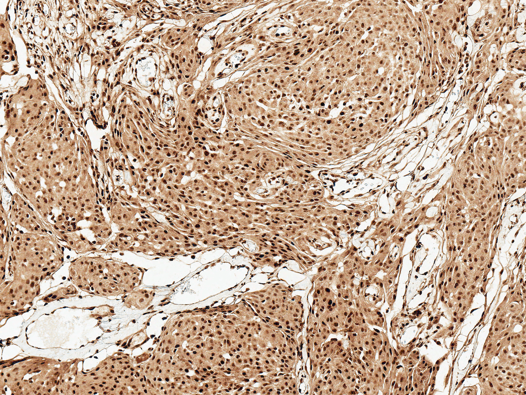 <p>Immunohistochemistry analysis using Rabbit Anti-FUNDC1 Polyclonal Antibody (SPC-638). Tissue: Brain. Species: Human. Fixation: Formalin Fixed Paraffin-Embedded. Primary Antibody: Rabbit Anti-FUNDC1 Polyclonal Antibody (SPC-638) at 1:50 for 30 min at RT. Counterstain: Hematoxylin. Magnification: 10X. HRP-DAB Detection.</p>
