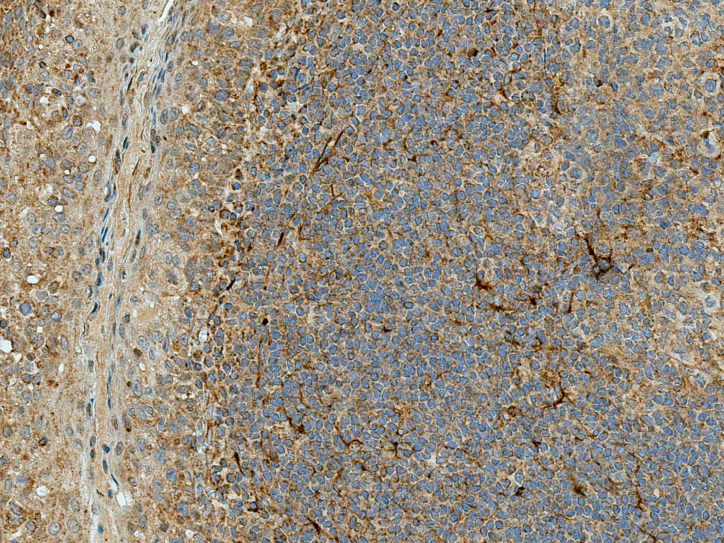 <p>Immunohistochemistry analysis using Rabbit Anti-Rubicon Polyclonal Antibody (SPC-668). Tissue: Tonsil. Species: Human. Fixation: Formalin Fixed Paraffin-Embedded. Primary Antibody: Rabbit Anti-Rubicon Polyclonal Antibody (SPC-668) at 1:50 for 30 min at RT. Counterstain: Hematoxylin. Magnification: 20X. HRP-DAB Detection.</p>
