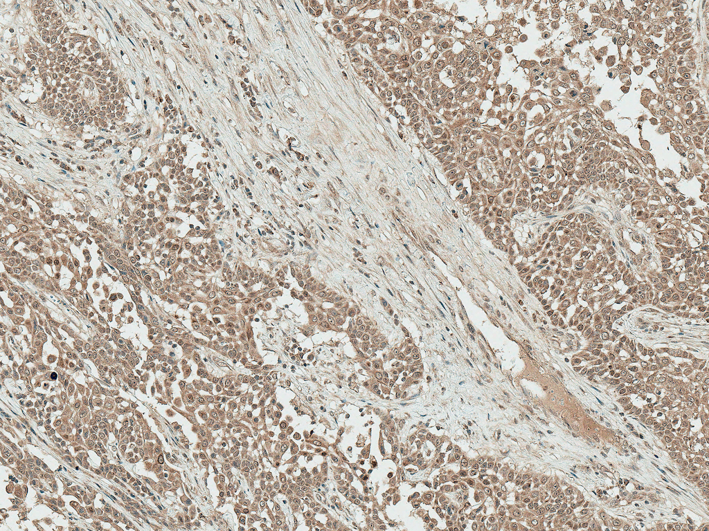 <p>Immunohistochemistry analysis using Rabbit Anti-IGF-1 Polyclonal Antibody (SPC-699). Tissue: Liver. Species: Human. Fixation: Formalin Fixed Paraffin-Embedded. Primary Antibody: Rabbit Anti-IGF-1 Polyclonal Antibody (SPC-699) at 1:50 for 30 min at RT. Counterstain: Hematoxylin. Magnification: 10X. HRP-DAB Detection.</p>
