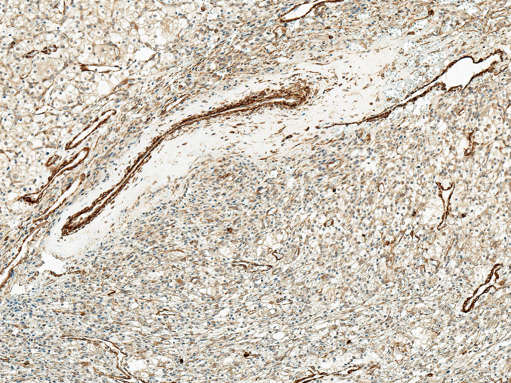 <p>Immunohistochemistry analysis using Rabbit Anti-Kir4.1 Polyclonal Antibody (SPC-700). Tissue: Kidney. Species: Human. Fixation: Formalin Fixed Paraffin-Embedded. Primary Antibody: Rabbit Anti-Kir4.1 Polyclonal Antibody (SPC-700) at 1:50 for 30 min at RT. Counterstain: Hematoxylin. Magnification: 10X. HRP-DAB Detection.</p>
