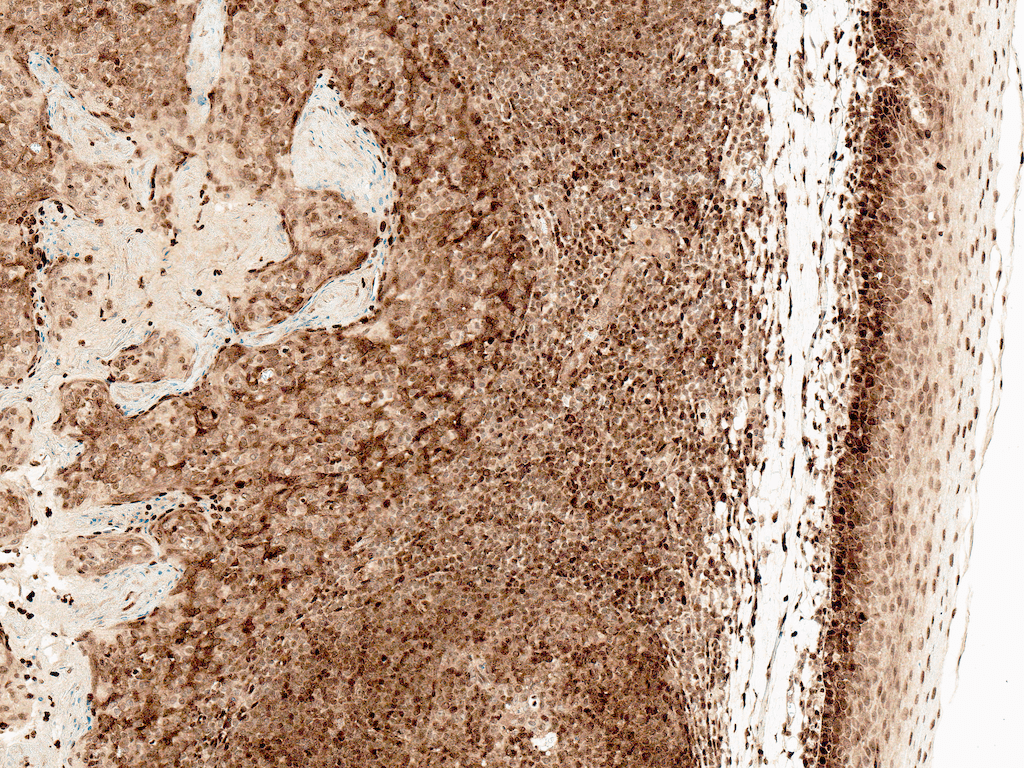 <p>Immunohistochemistry analysis using Rabbit Anti-CCR2 Polyclonal Antibody (SPC-704). Tissue: Tonsil. Species: Human. Fixation: Formalin Fixed Paraffin-Embedded. Primary Antibody: Rabbit Anti-CCR2 Polyclonal Antibody (SPC-704) at 1:50 for 30 min at RT. Counterstain: Hematoxylin. Magnification: 10X. HRP-DAB Detection.</p>
