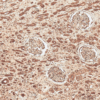 Rabbit Anti-FNP1 Antibody used in Immunohistochemistry (IHC) on Renal Cell Carcinoma (SPC-718)