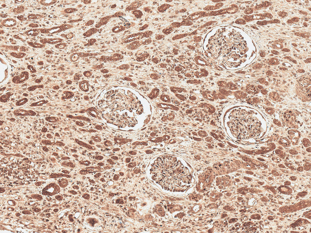 <p>Immunohistochemistry analysis using Rabbit Anti-FNP1 Polyclonal Antibody (SPC-718). Tissue: Renal Cell Carcinoma. Species: Human. Fixation: Formalin Fixed Paraffin-Embedded. Primary Antibody: Rabbit Anti-FNP1 Polyclonal Antibody (SPC-718) at 1:50 for 30 min at RT. Counterstain: Hematoxylin. Magnification: 10X. HRP-DAB Detection.</p>
