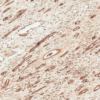 Rabbit Anti-FNP1 Antibody used in Immunohistochemistry (IHC) on Renal Cell Carcinoma (SPC-718)