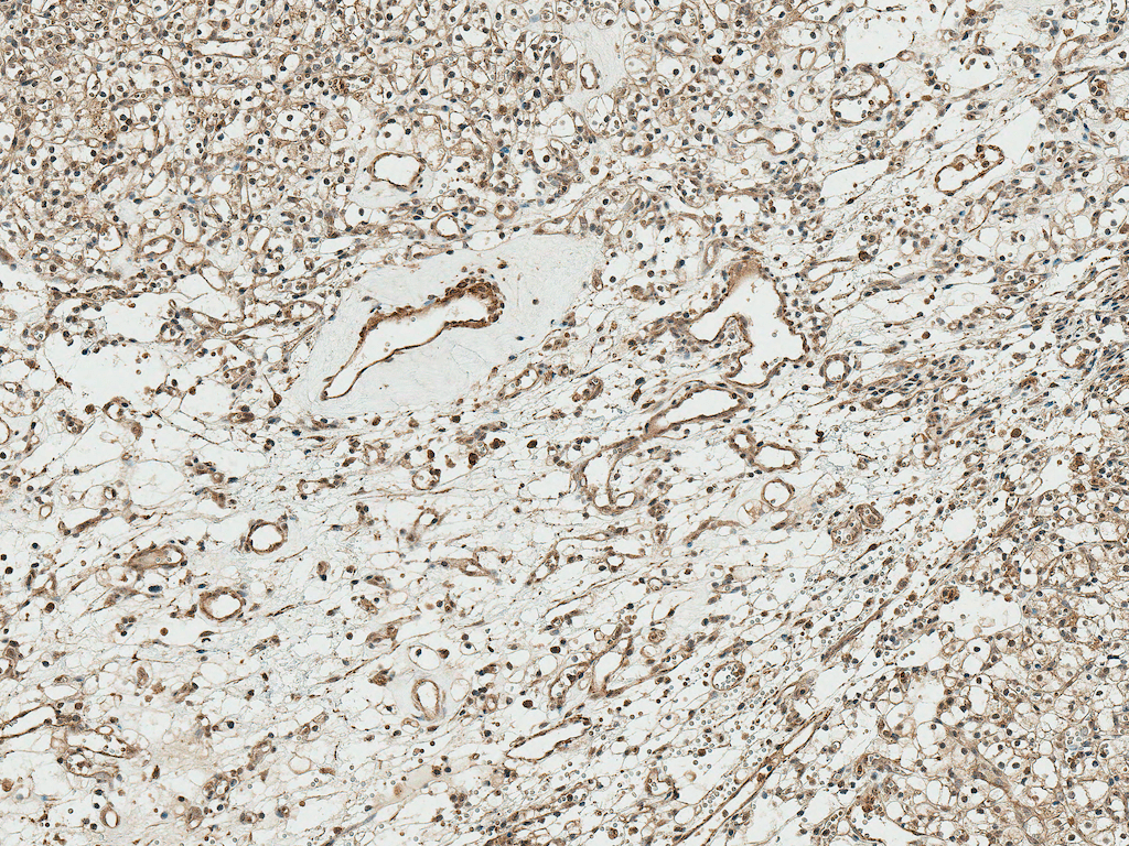 <p>Immunohistochemistry analysis using Rabbit Anti-TCF4 Polyclonal Antibody (SPC-723). Tissue: Kidney. Species: Human. Fixation: Formalin Fixed Paraffin-Embedded. Primary Antibody: Rabbit Anti-TCF4 Polyclonal Antibody (SPC-723) at 1:50 for 30 min at RT. Counterstain: Hematoxylin. Magnification: 10X. HRP-DAB Detection.</p>
