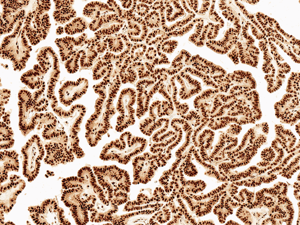 <p>Immunohistochemistry analysis using Rabbit Anti-Wnt5a Polyclonal Antibody (SPC-737). Tissue: Thyroid Carcinoma. Species: Human. Fixation: Formalin Fixed Paraffin-Embedded. Primary Antibody: Rabbit Anti-Wnt5a Polyclonal Antibody (SPC-737) at 1:50 for 30 min at RT. Counterstain: Hematoxylin. Magnification: 10X. HRP-DAB Detection.</p>
