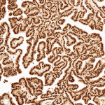 SPC-737_Wnt5a_Antibody_IHC_Human_Thyroid-Carcinoma_10X_1.png