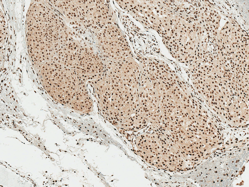 <p>Immunohistochemistry analysis using Rabbit Anti-Alpha Synuclein pSer129 Polyclonal Antibody (SPC-742). Tissue: Brain. Species: Human. Fixation: Formalin Fixed Paraffin-Embedded. Primary Antibody: Rabbit Anti-Alpha Synuclein pSer129 Polyclonal Antibody (SPC-742) at 1:50 for 30 min at RT. Counterstain: Hematoxylin. Magnification: 10X. HRP-DAB Detection.</p>
