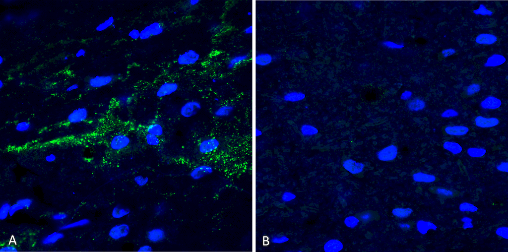 <p>Immunohistochemistry analysis using Rabbit Anti-Alpha Synuclein (pSer129) Polyclonal Antibody (SPC-742). Tissue: Free floating brain sections. Species: Mouse. Fixation: PFA. Primary Antibody: Rabbit Anti-Alpha Synuclein (pSer129) Polyclonal Antibody (SPC-742) at 1:500 for overnight at 4C with gentle agitation. Counterstain: Hoechst. Magnification: 63X. A) Right hemisphere (striatum) injected with alpha synuclein AAV vector. B) Control. Alpha synuclein streaks are visible at injection site, but not control, 4 months after injection. Courtesy of: Trine Rasmussen, Simon Molgaard Jensen, Aarhus University.</p>
