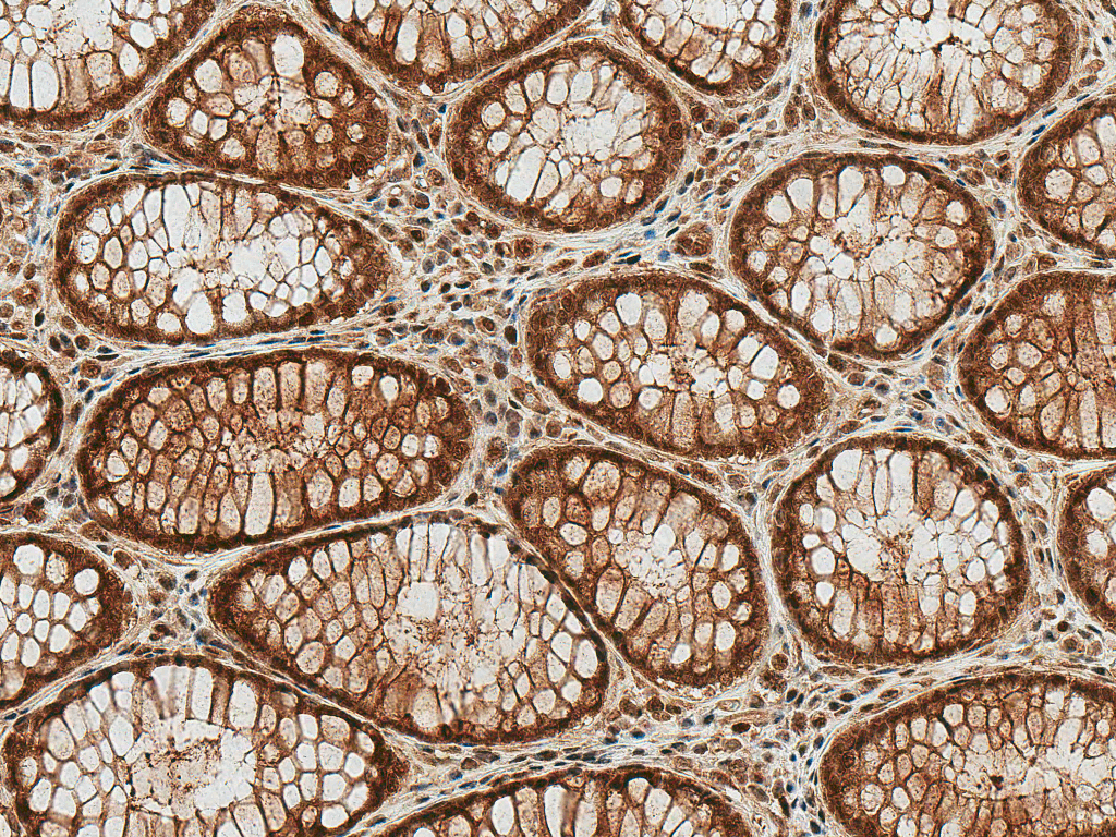 <p>Immunohistochemistry analysis using Rabbit Anti-HSP70 (Acetyl Lys77) Polyclonal Antibody (SPC-743). Tissue: Colon Cancer. Species: Human. Fixation: Formalin Fixed Paraffin-Embedded. Primary Antibody: Rabbit Anti-HSP70 (Acetyl Lys77) Polyclonal Antibody (SPC-743) at 1:50 for 30 min at RT. Counterstain: Hematoxylin. Magnification: 20X. HRP-DAB Detection.</p>
